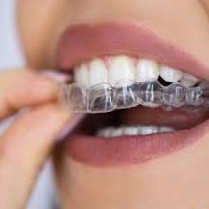 Aligners