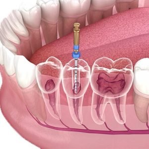 root canal